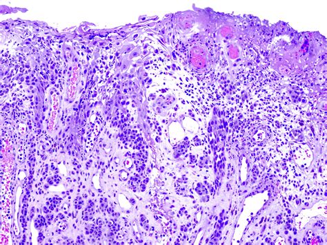 Acral Lentiginous Melanoma Metastatic Melanoma