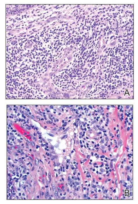 Erythematous Papule on the Nasal Ala | MDedge Dermatology