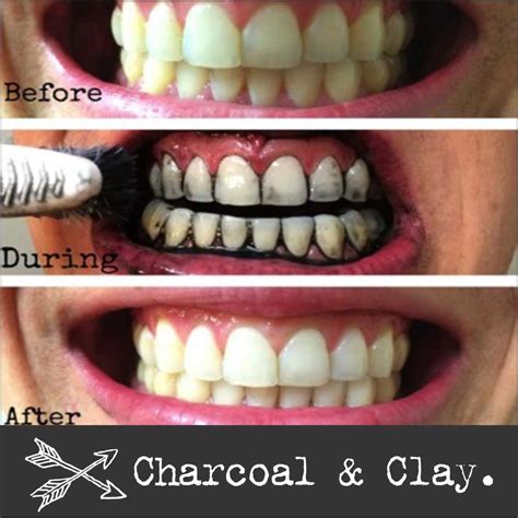 Activated Charcoal Teeth Whitening Before And After - Teeth Poster