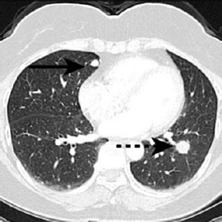 Chest CT lung window images. An 18-mm, spiculated nodule with surface... | Download Scientific ...