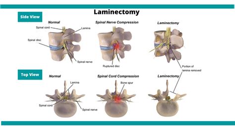 Laminectomy or Spinal Decompression Surgery in Mumbai | Dr Bhavin Shial