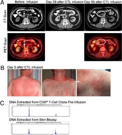 Complete response associated with a skin rash infiltrated with the ...