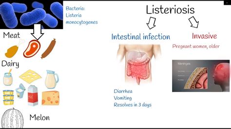 listeriosis - Symptoms and treatment. Listeria monocytogenes. - YouTube