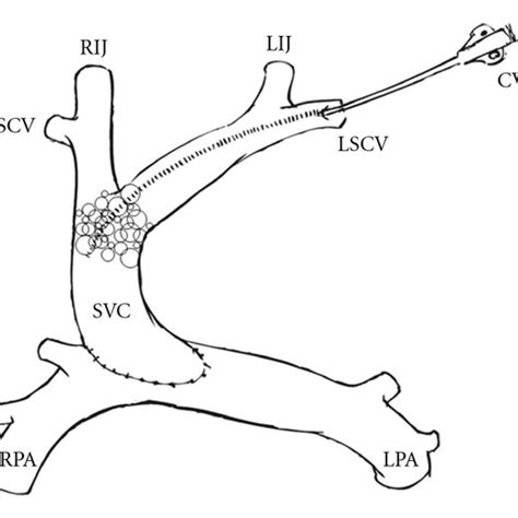 Preoperative anatomy (mBTS: modified Blalock-Taussig Shunt; PA ...