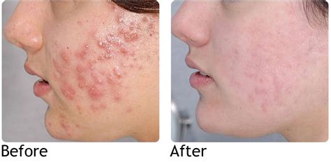 Natural treatment of Acne, improvement within 6-8 weeks, cure within 8-12 months