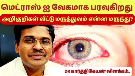 madras eye treatment symptoms home remedies in tamil ! | dr karthikeyan ...