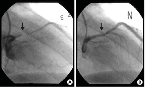 A representative case of coronary artery vasospasm documented by... | Download Scientific Diagram