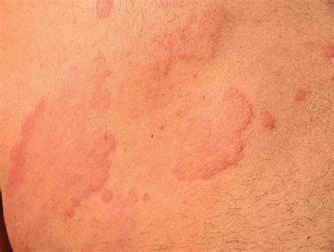 Gallery of Hives Pictures for Identifying Rashes