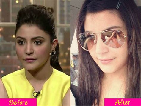 Anushka Sharma’s lips go back to normal! - Bollywoodlife.com