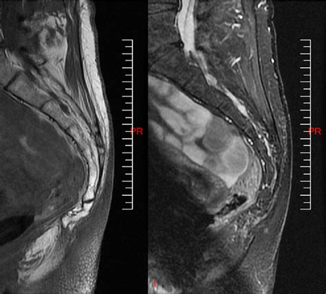 Figure 6 from Magnetic resonance imaging findings in the painful adult coccyx | Semantic Scholar