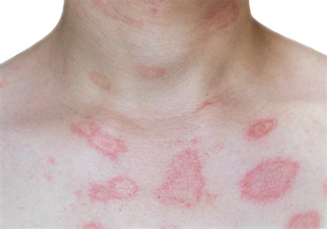 Skin Rashes: When To See A Dermatologist - Goodless Dermatology