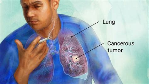 Wellness Lab Health Info: How Smoking Causes Cancer