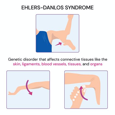 Ehlers Danlos Syndrome & The Eyes