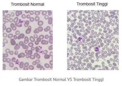 Inilah Penyebab Trombosit Tinggi dan Penyebabnya