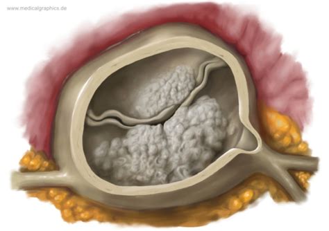 Free Illustration Aortic valve calcification