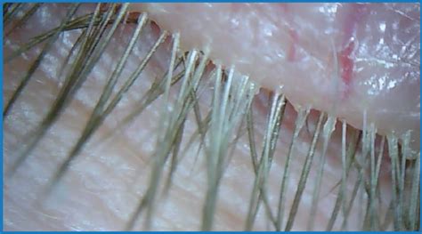 CRSToday | Collarettes Equal Demodex Blepharitis