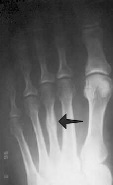 Metatarsal Stress Fracture