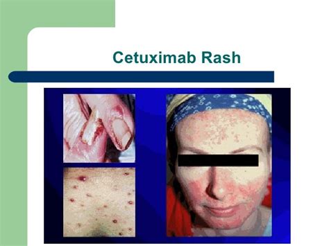 Cetuximab Plus Radiotherapy For Head And Neck Cancer