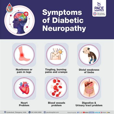 Proximal Neuropathy