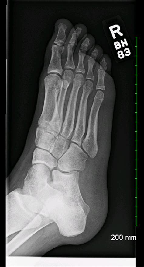 Archive Of Unremarkable Radiological Studies: Foot X-Ray - Stepwards