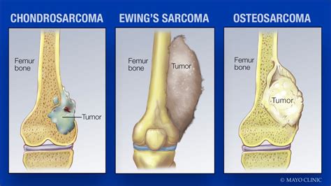 Mayo Clinic Q&A podcast: Be aware of the rare cancer called sarcoma ...