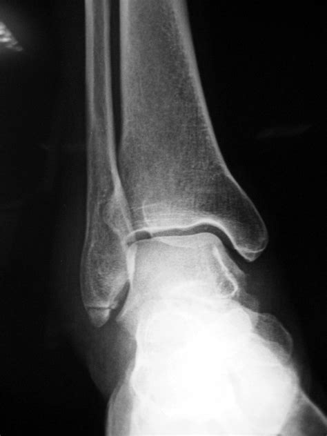 Avulsion Fracture Ankle