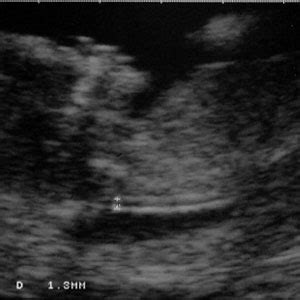 Nuchal translucency (NT) ultrasound - BabyCenter Canada