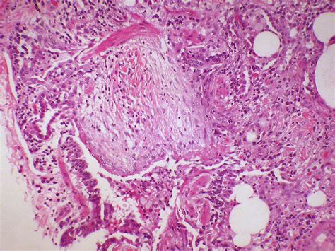 Cryptogenic organizing pneumonia (COP)-bronchiolitis oblit… | Flickr