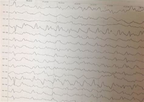 EEG showing periodic triphasic sharp waves. | Download Scientific Diagram