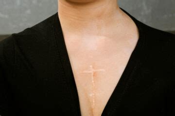 Open Heart Surgery Scar Healing: How to care scars | Miami, FL