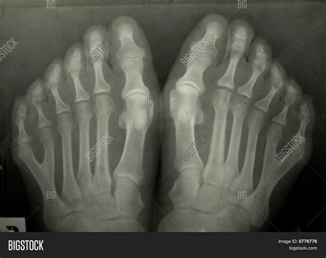 X-ray Photo Person's Toes. 6 Toes Image & Photo | Bigstock