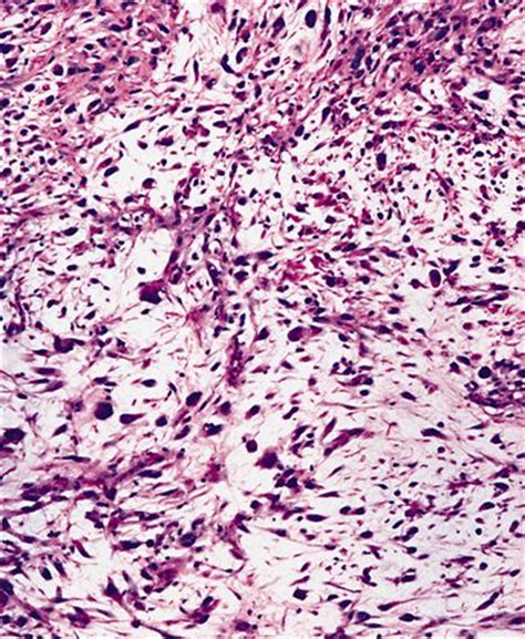 Pathology Outlines - Myxofibrosarcoma