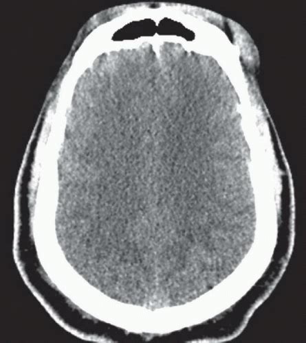 Diffuse Axonal Injury | Radiology Key