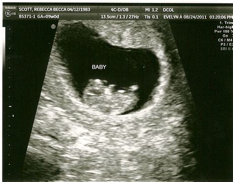 The Scotts: Baby Makes Three: First Ultrasound...9 weeks