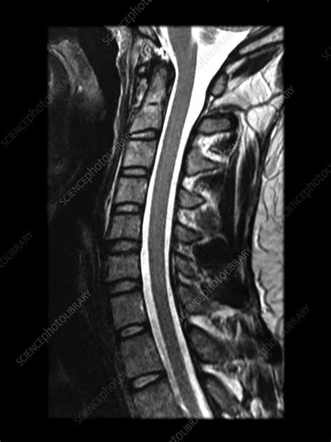 Normal MRI Cervical Spine - Stock Image - C043/0139 - Science Photo Library