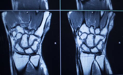 Tfcc Wrist Mri