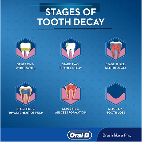 Stages of Tooth Decay - Oral-B