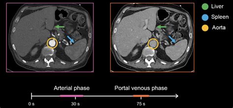 Abdominal CT: Phases • LITFL • Radiology library