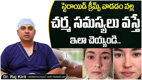 స్టెరాయిడ్ క్రీమ్స్ సైడ్ ఎఫెక్ట్స్| How to Recover from Steroid Cream Side Effects | Celestee ...