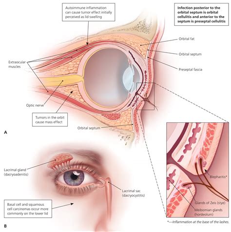 Pimple On Eyelid - Types, Causes & How To Treat Them