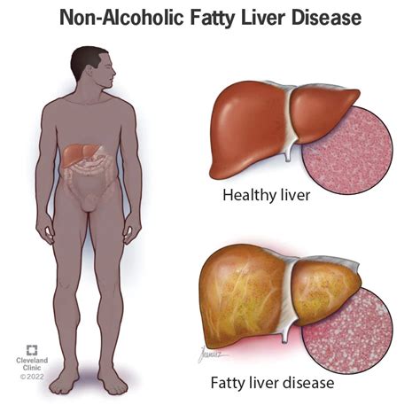 Early Signs of Non-Alcoholic Fatty Liver Disease - Fundahigado America