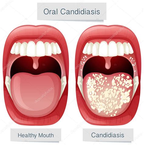 Human Mouth Anatomy Oral Candidiasis — Stock Vector © blueringmedia #195474998