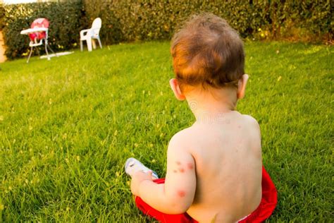 New Born with Multiple Mosquito Bites. Allergy To Insect Bites Stock Photo - Image of fever ...