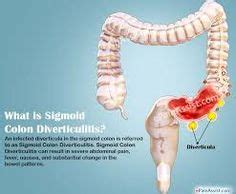 sigmoid colon