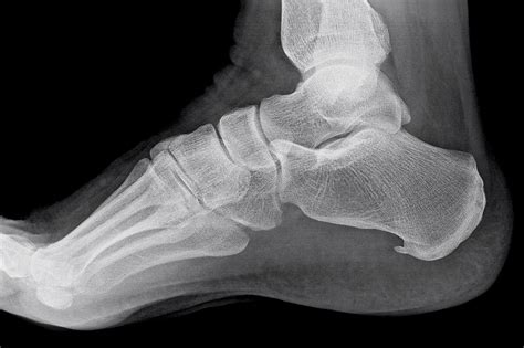 Plantar Calcaneal Enthesophyte