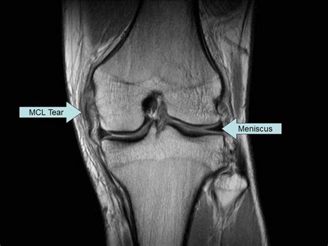 MCL tear on coronal MRI of knee | Magnetic resonance imaging, Knee mri ...