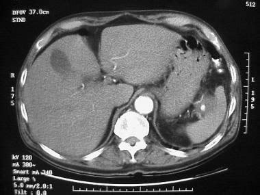 Pancreatic Pseudocyst Imaging: Overview, Radiography, Computed Tomography