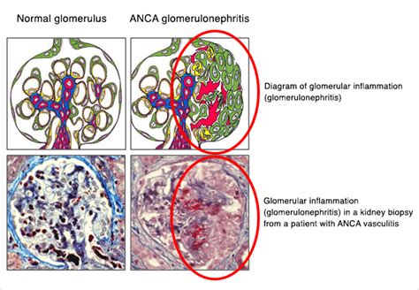 ANCA Vasculitis | UNC Kidney Center