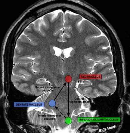 Hypertrophic olivary degeneration | Radiology Reference Article ...