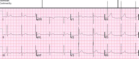 Dr. Smith's ECG Blog: Is this Type 2 Brugada syndrome/ECG pattern?